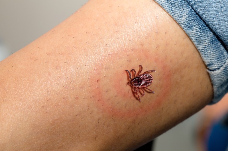 Signs You Might Have Lyme Disease