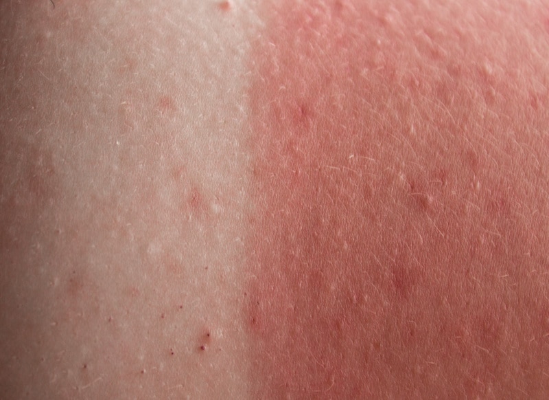 How to Treat 
a Sunburn